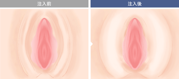 脂肪注入のイメージ
