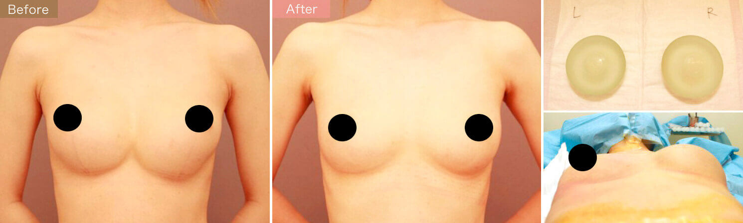 シリコンバッグ抜去＆コンデンスリッチ豊胸【術前／3ヶ月 24歳 バッグ：片側230cc】の症例写真
