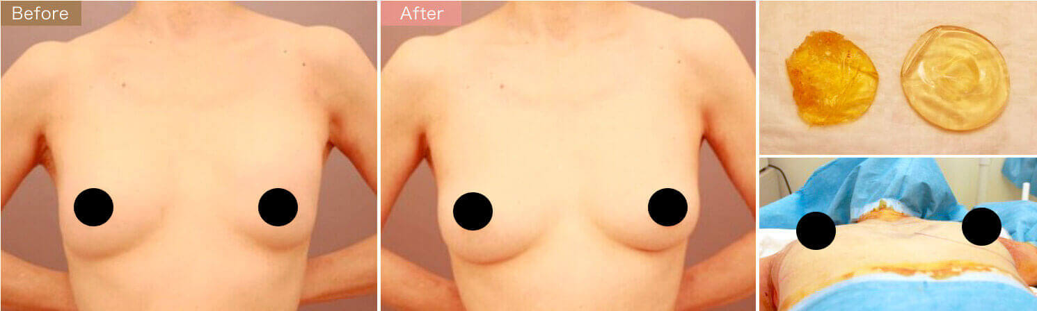 シリコンバッグ抜去＆コンデンスリッチ豊胸【術前／3ヶ月 55歳 　バッグ：片側150cc】の症例写真