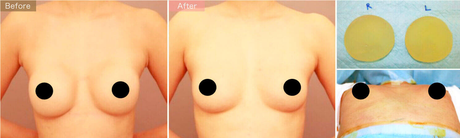 シリコンバッグ抜去＆コンデンスリッチ豊胸【術前／6ヶ月 36歳 　バッグ：片側215cc】の症例写真
