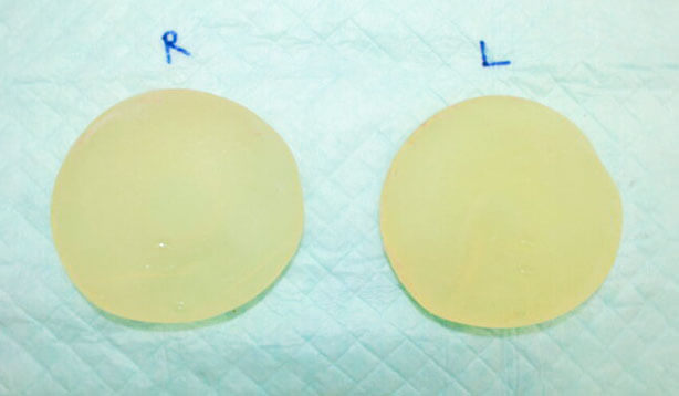 シリコンバッグ抜去