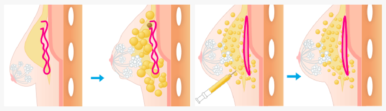 1日で施術が完了の図説