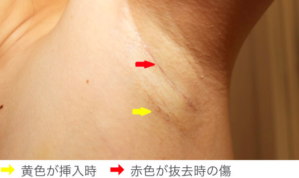 傷跡は小さく、目立たない位置に作る