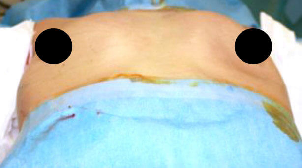 当院の推奨は『シリコンバッグ除去とコンデンスリッチ豊胸』