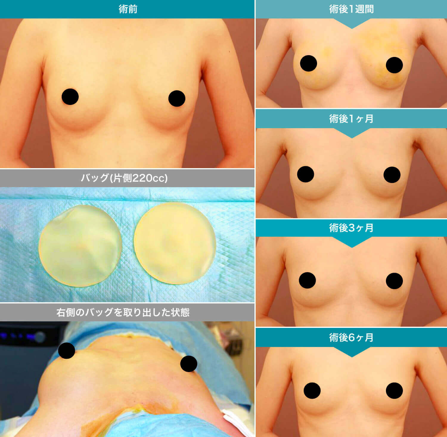 シリコンバッグ除去とコンデンスリッチ豊胸の経過写真